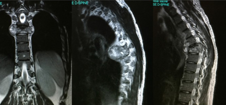 Glioma Surgery